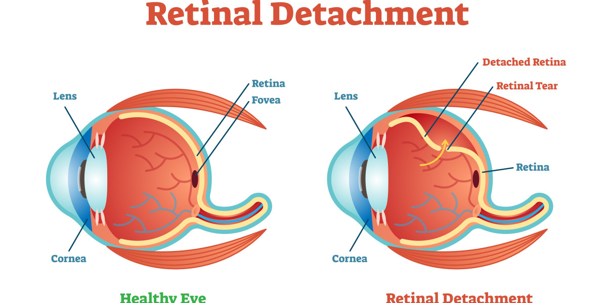 Understanding Retina and Detached Retina: Symptoms and Causes