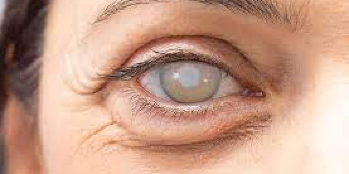 Comparing Cataract Surgery Options: Which is Best for You