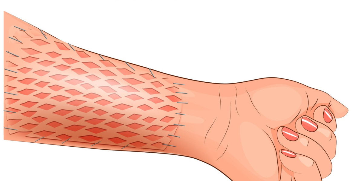 Skin Graft Market: Insights, Trends, and Outlook