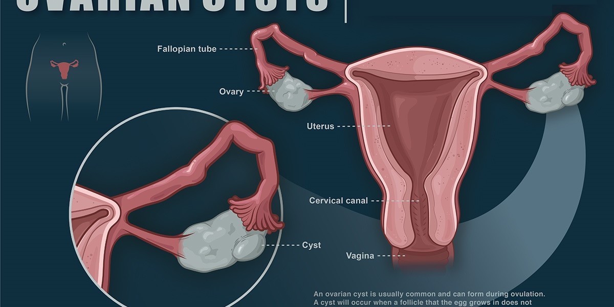 Ovarian Cysts Market Share & Size 2023–2032 with Latest Industry Trends
