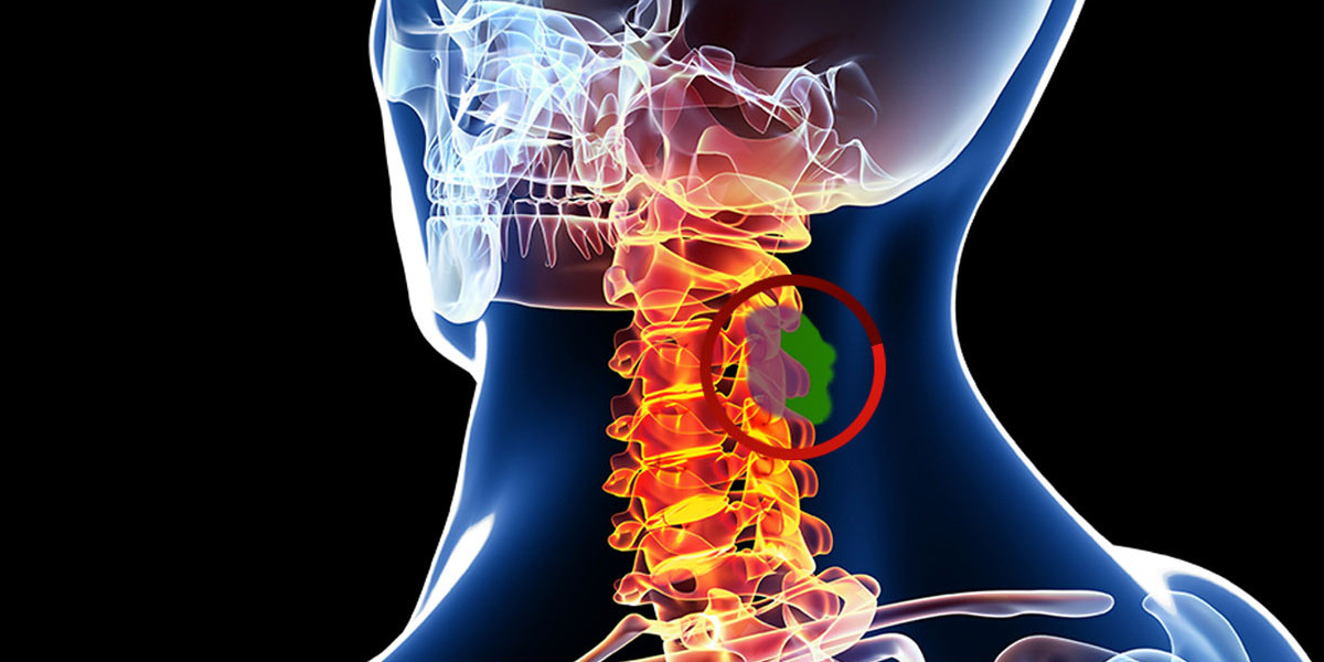 Metastases Spinal Tumor Market Size to Reach $2.1 Billion by 2030: Driven by Rising Spinal Metastases