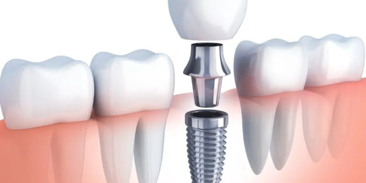 Understanding Bone Grafting in Dentistry: Restoring Oral Health and Function