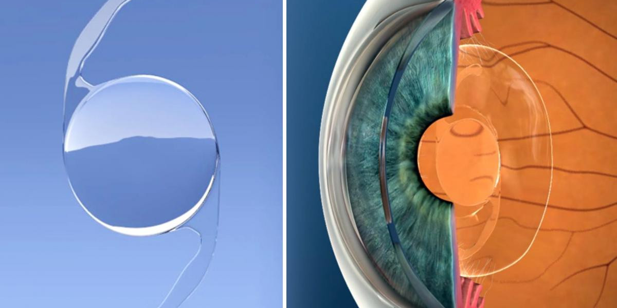 Intraocular Lens Market Share of Top Key Players with Tactics for Industry Growth