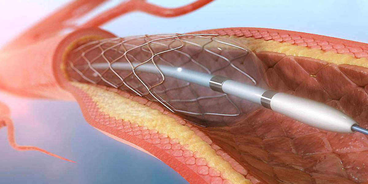 Global Cerebral Vascular Stent Market Share Emergence 2022-2030, Insights on Industry Size & Growth