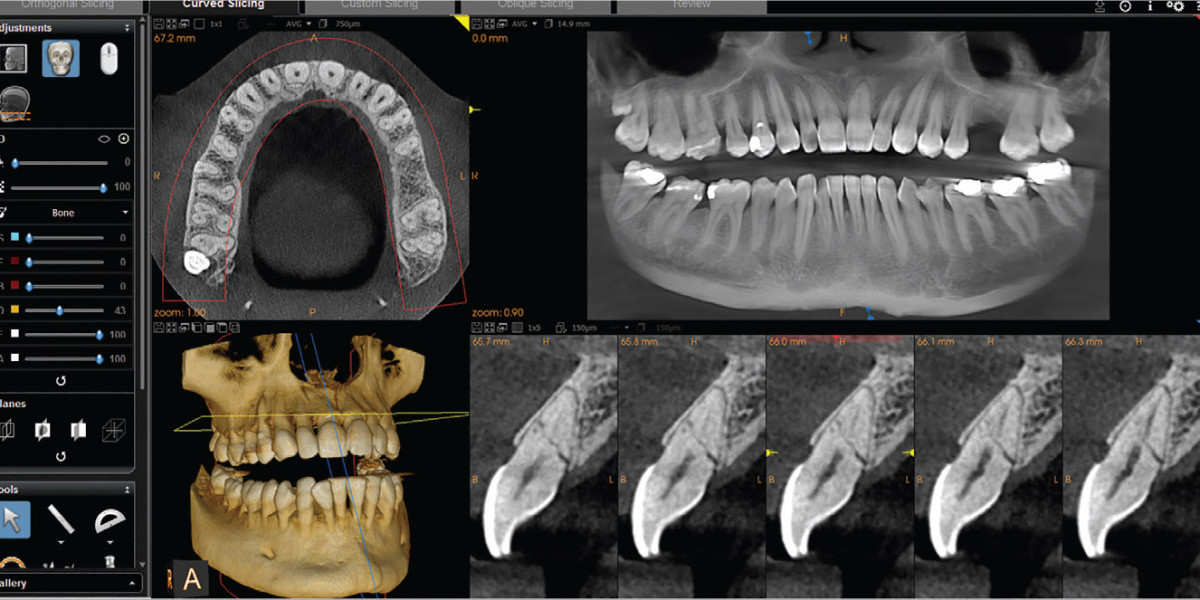 Elevating Dental Diagnosis: The Power of Cone Beam Dental X-Ray Systems