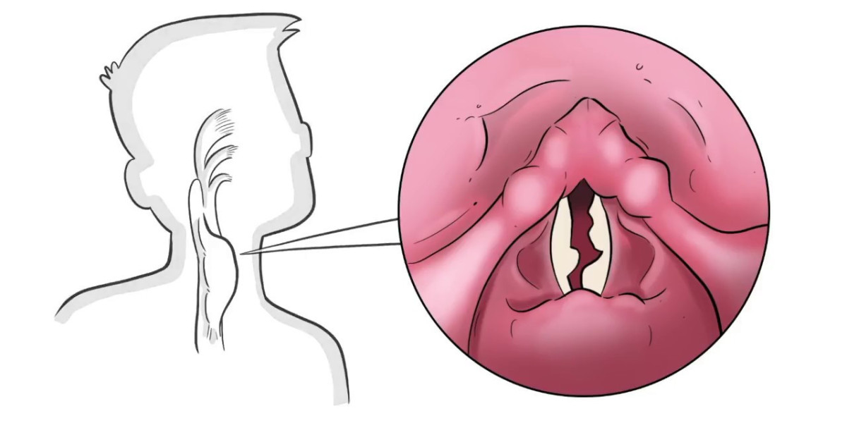 Restoring Harmony: Innovative Treatments for Vocal Cord Paralysis
