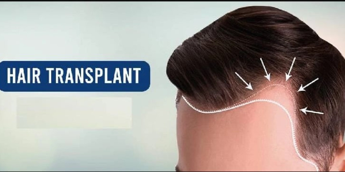 Understanding the Hair Transplant Process: A Comprehensive Guide