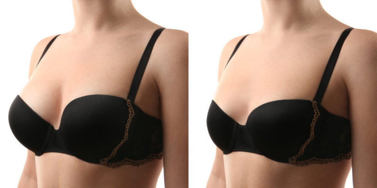Types of Breast Reduction Surgery: Liposuction, Excision, or Combination
