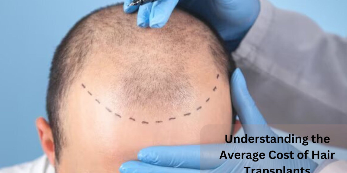 Understanding the Average Cost of Hair Transplants