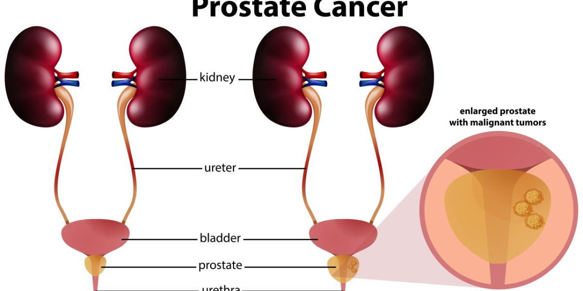 Prostate Cancer Treatment Market Share, Growth, Trends, Report 2024-2032