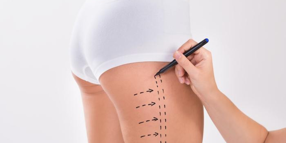 What to Look for in a Liposuction Consultation