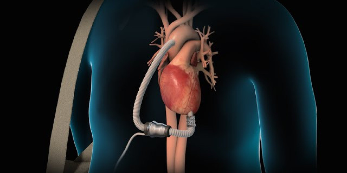 Ventricular Assist Devices: A Life-Saving Technology For Heart Failure Patients