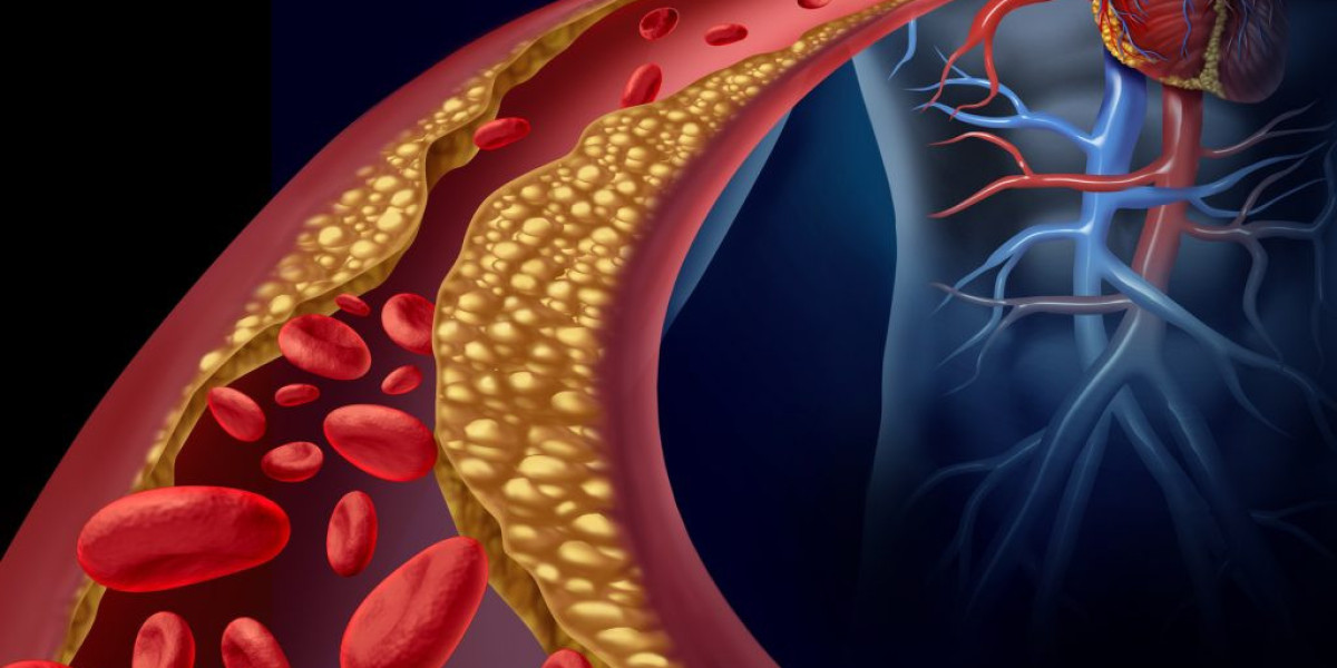 Natural Supplements and Their Role in High Cholesterol Treatment in Sycamore