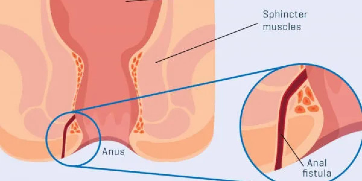 Top Fistula Surgeon Mumbai Share Their Secrets: From Diagnosis to Healing