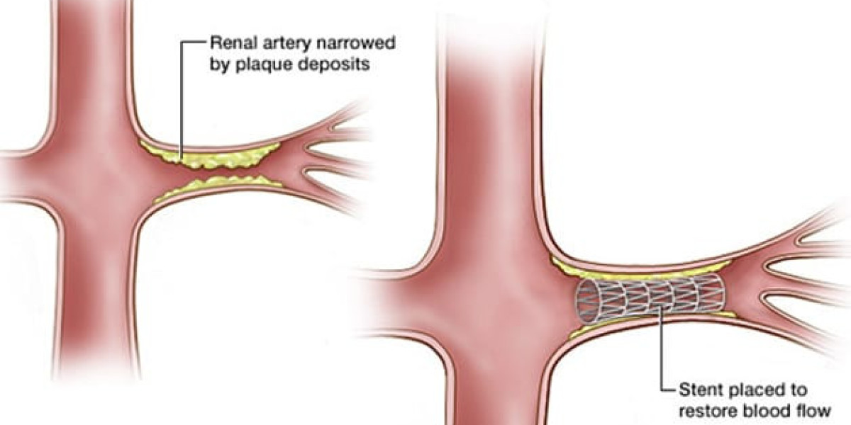 Renal Angiography in Jaipur: Advanced Diagnostics for Optimal Kidney Health