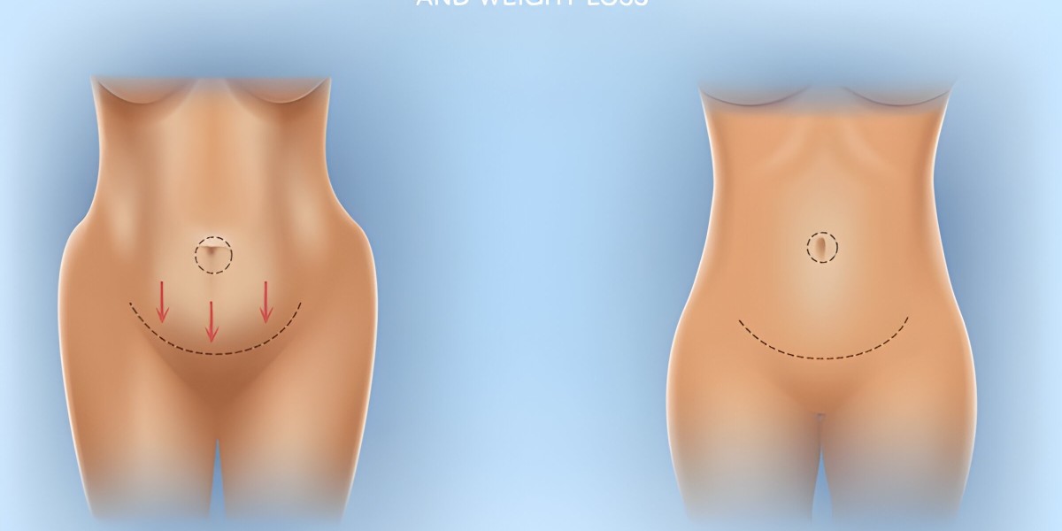 Tummy Tuck in Salt Lake City: Achieve a Flatter, Toned Abdomen