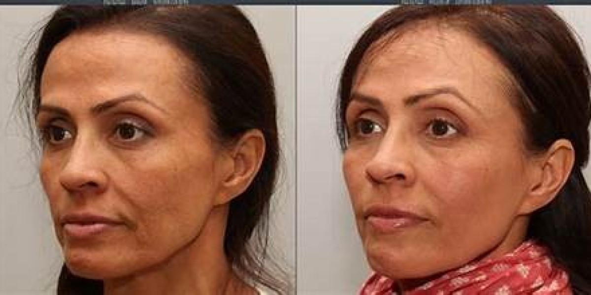 Say Goodbye to Double Chin: Kybella Injections in Torrance, CA