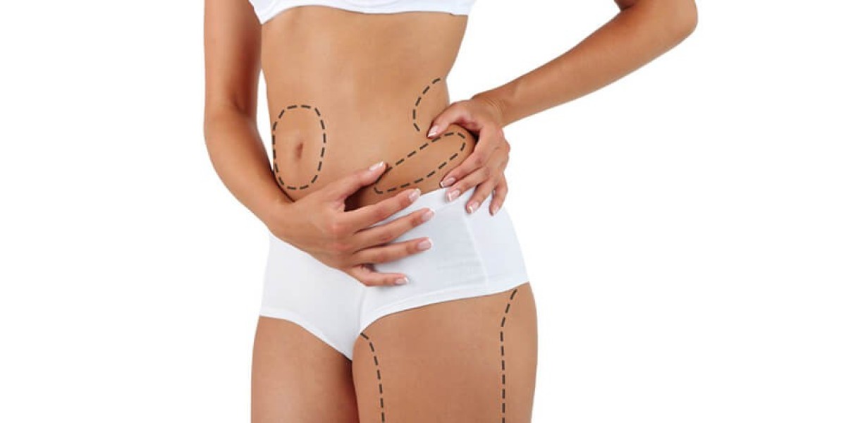 How Long Do Liposuction Results Last? Insights from Islamabad Surgeons: