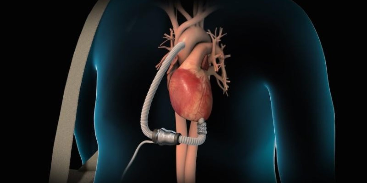 Ventricular Assist Devices Market Poised to Witness High Growth Due to Technological Advancements in LVAD Systems