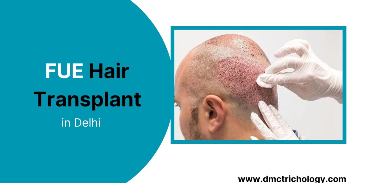 Key Benefits of FUE Hair Transplant You Should Know