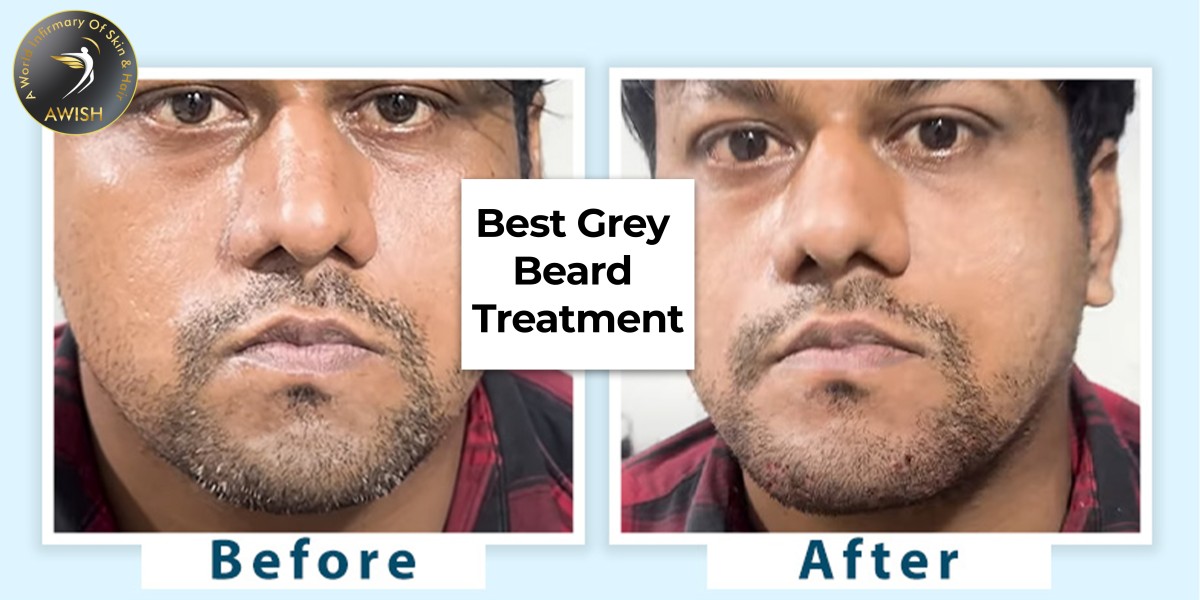 Best Gray Beard Treatment Options Available in Delhi ?