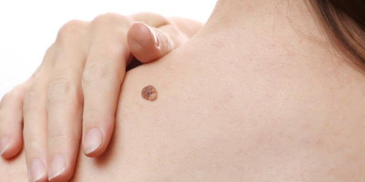 Skin Tag Removal: Expert Treatment for Smooth, Healthy Skin