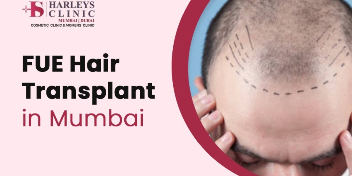 FAQs on FUE Hair Transplant