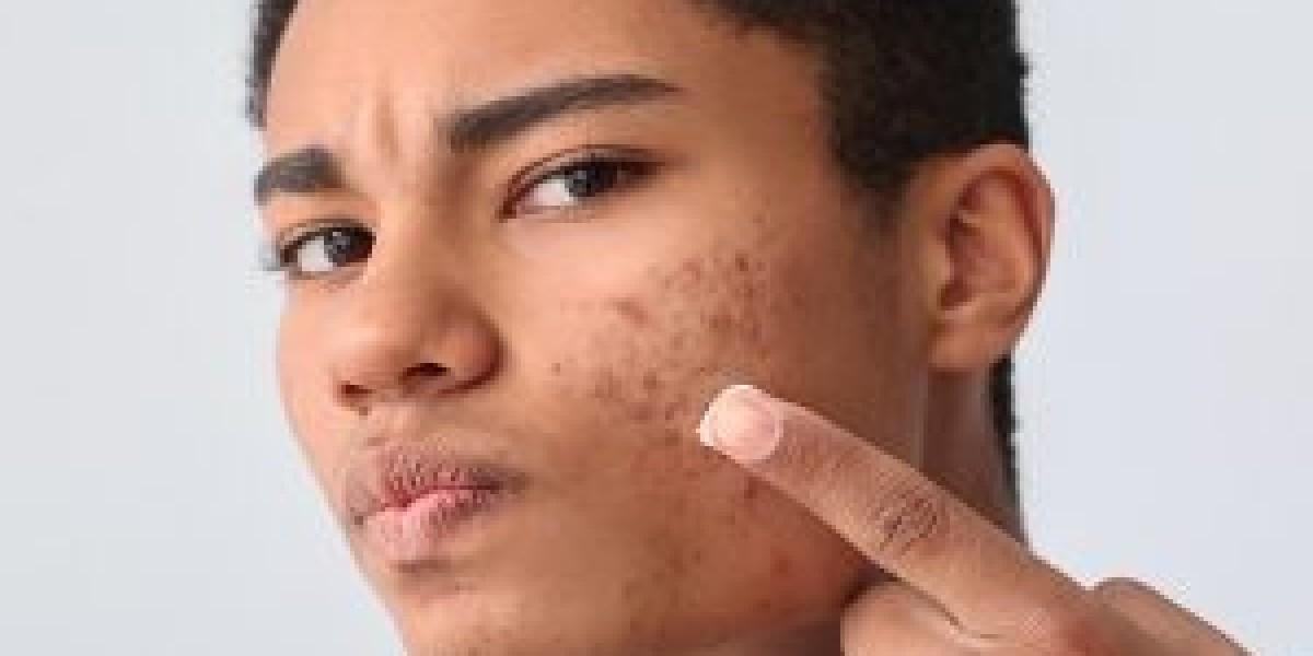 IPL Therapy for Acne: Is It Effective?