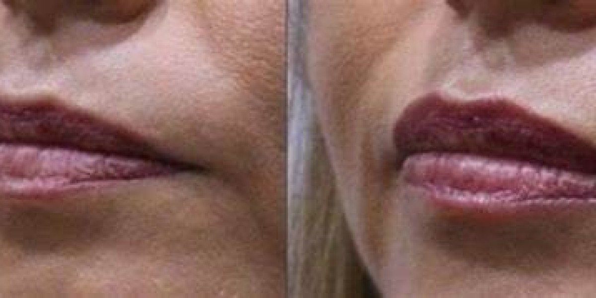 Botox in Torrance, CA: Unlocking a Youthful Appearance