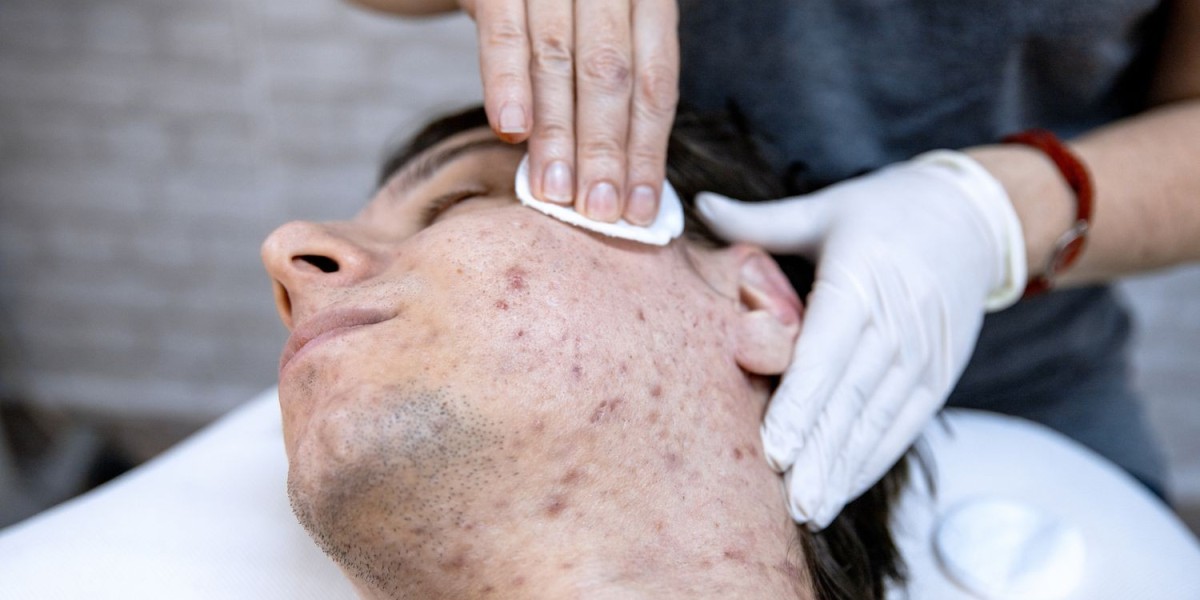 Acne Treatment Market worth USD 16,890 Million Globally by 2033 with 5.6% CAGR | Exclusive Report by We Market Research