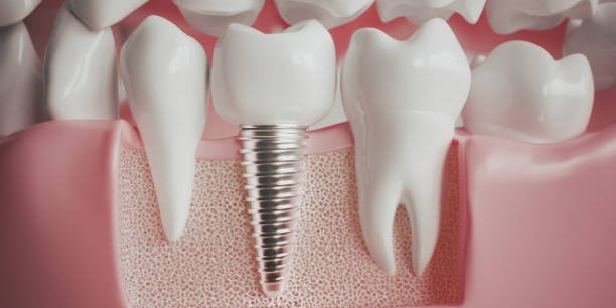 Unlocking Confidence: Know About Dental Implants