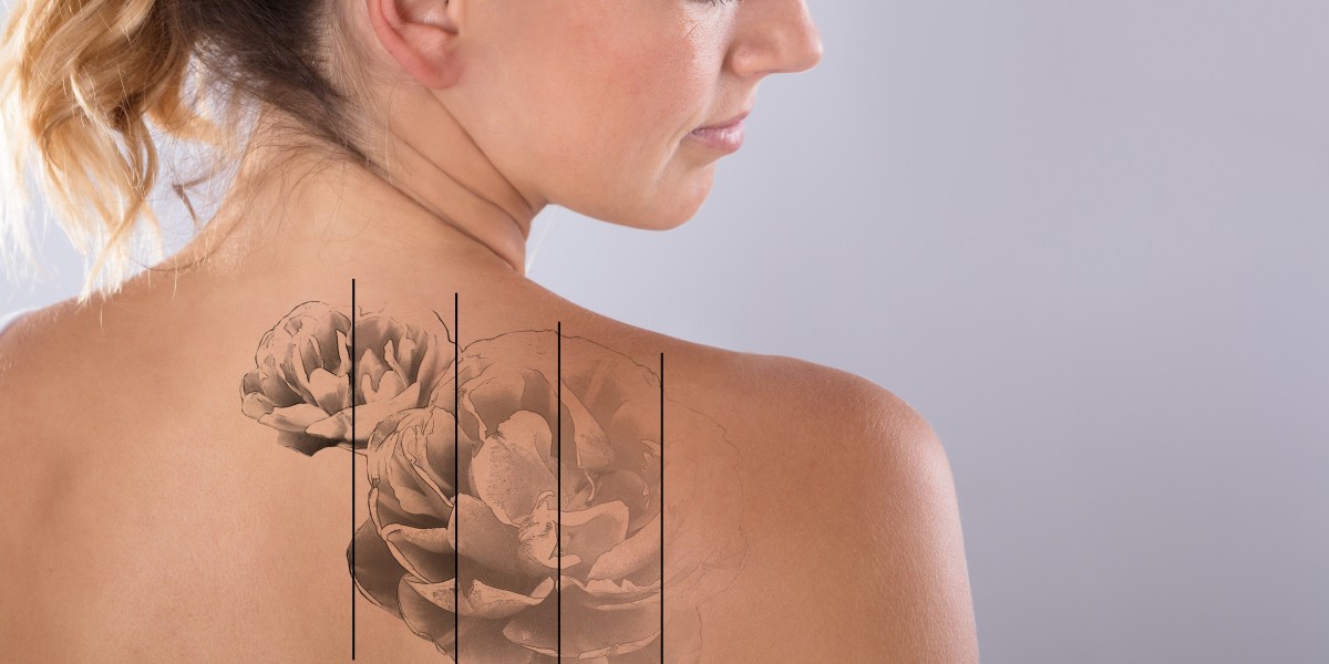 How Does the Immune System Help in Laser Tattoo Removal?