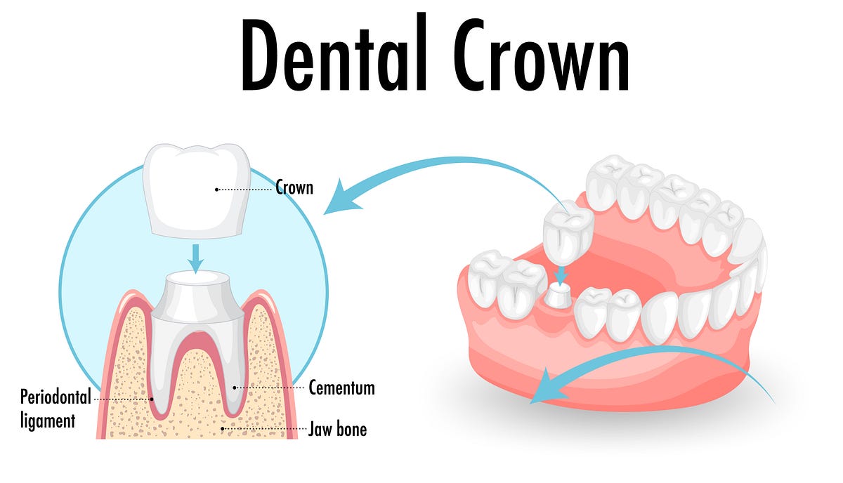 Dental Crown in Faridabad — Dr. Dipti’s Smile Suite | by Dr. Dipti Smile Suite | Nov, 2024 | Medium