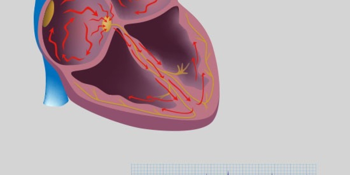 Atrial Fibrillation Market Key Players, Share & Forecast Report to 2032