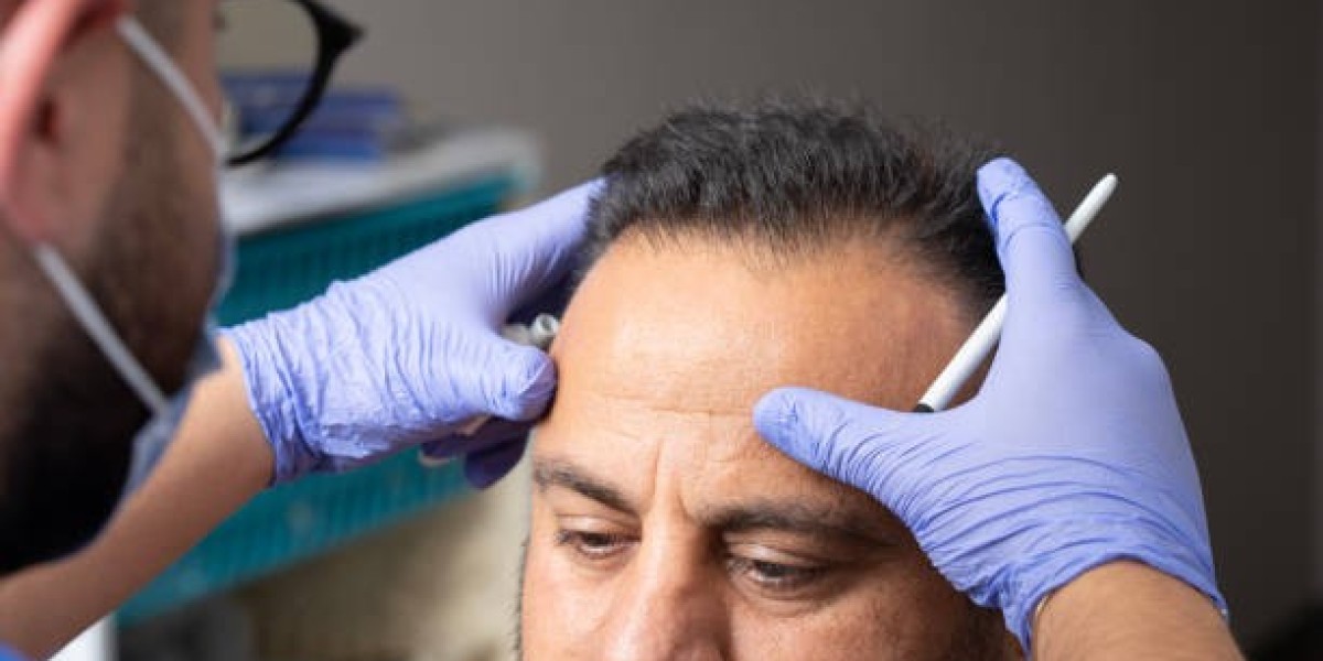 Transform Your Look: Sign up for Affordable Hair Transplant Options at HASH CLINICS