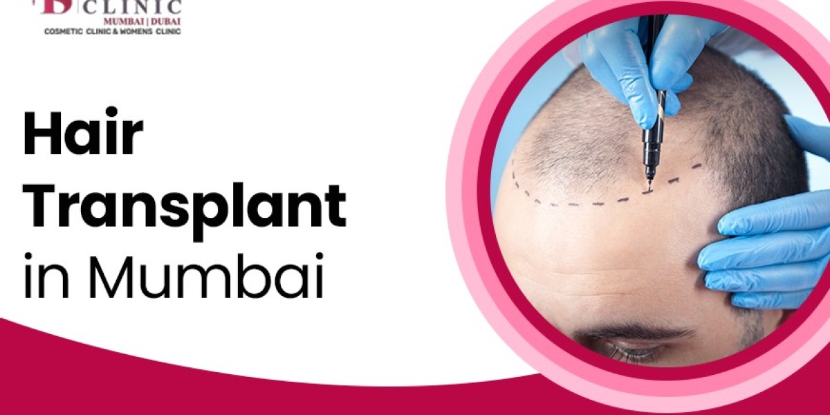 5 Benefits of FUE Hair Transplant Surgery