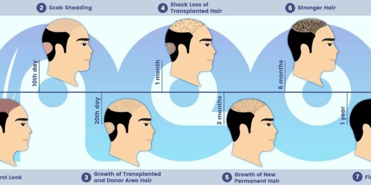 Hair Replacement Surgery in Turkey: A Comprehensive Guide to Restoring Your Confidence