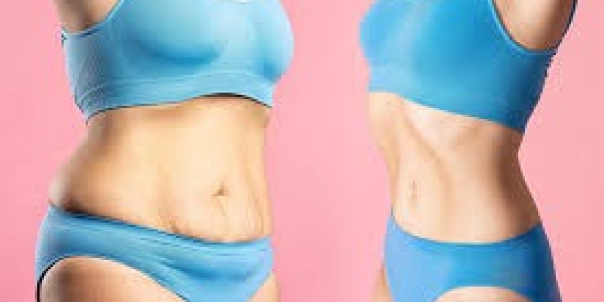 Best 5 Tummy Tuck Clinics in Raleigh, NC