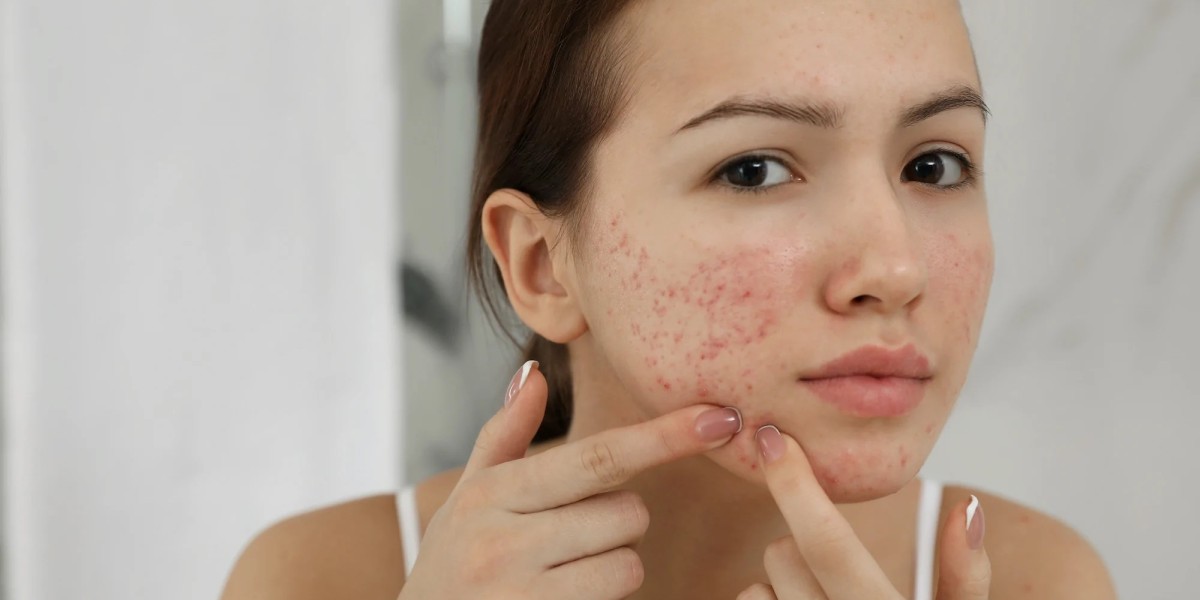 Achieving Clearer Skin: Your Guide to Acne Scar Treatment in Islamabad