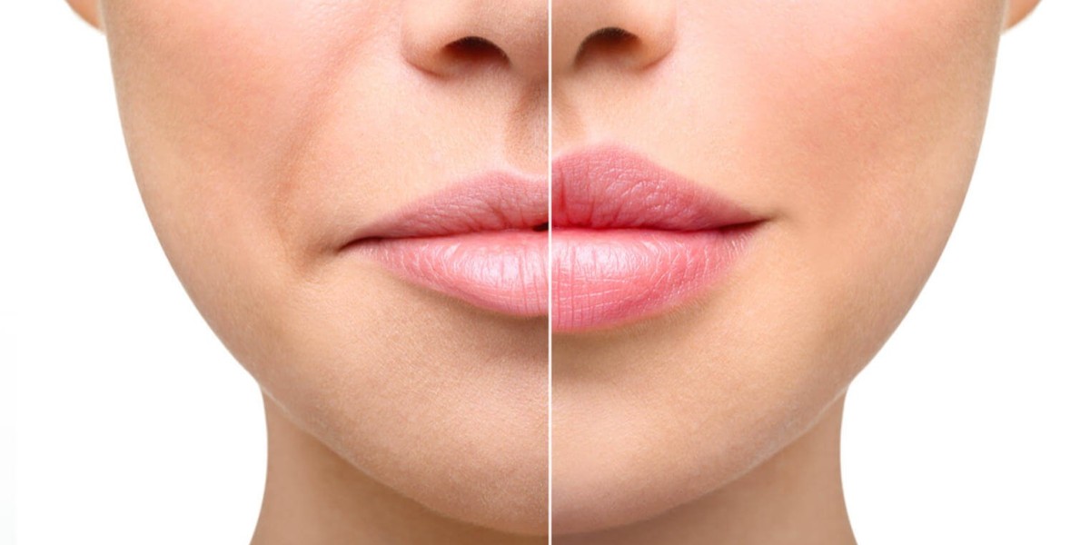 Celebrity-Inspired Lip Augmentation Trends in Islamabad