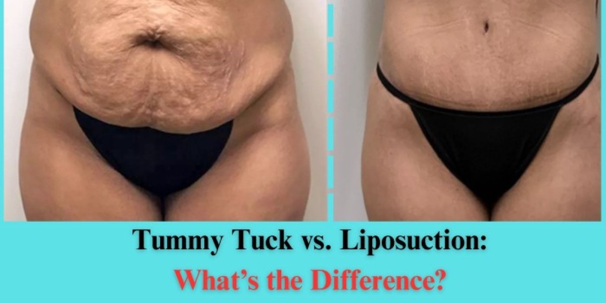 Tummy Tuck vs. Liposuction: What’s the Difference?