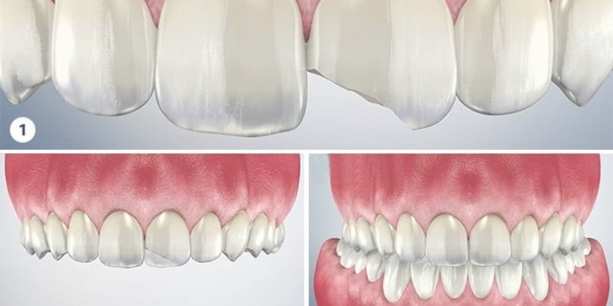 Transform Your Smile with Dental Bonding for Front Teeth