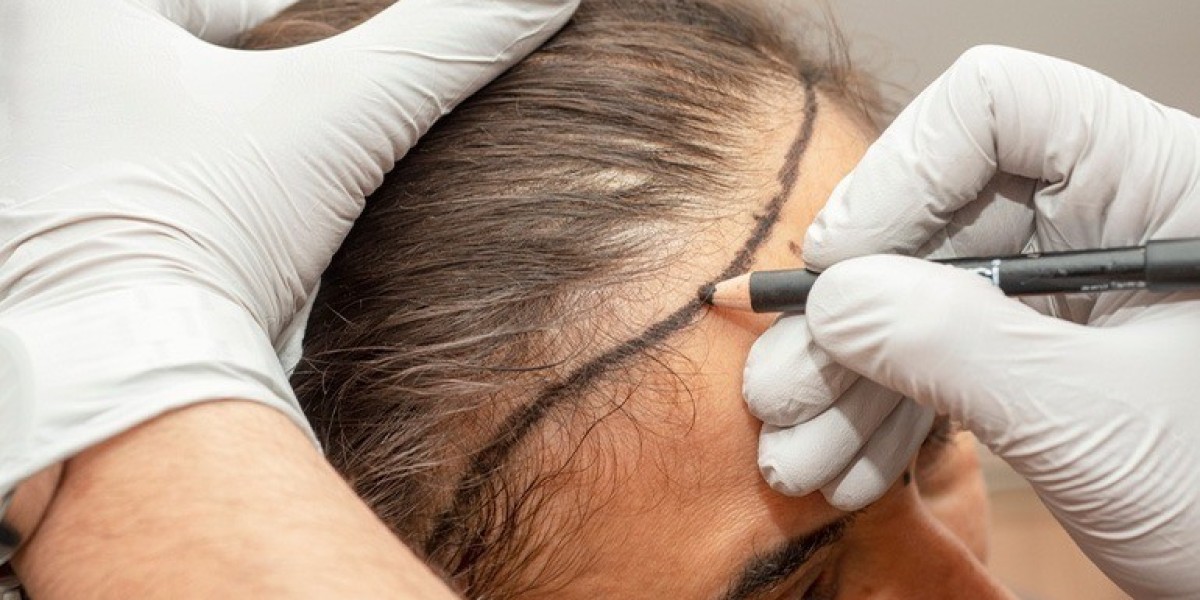 The Cost of Female Hair Transplants Explained