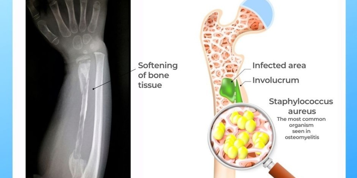 Osteomyelitis Treatment: A Comprehensive Guide