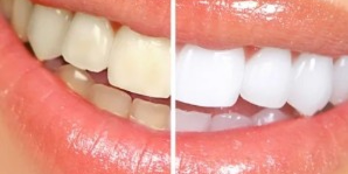 Top Reasons to Choose Our Teeth Whitening Service for a Brighter Smile