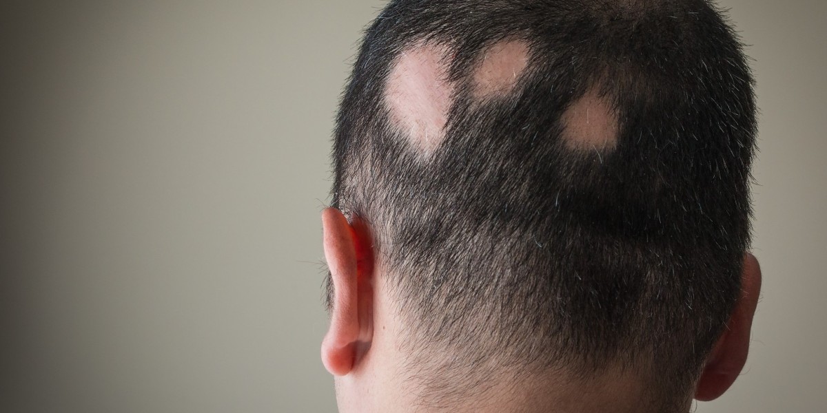 Why Islamabad Is a Hub for Alopecia Areata Treatment in Islamabad