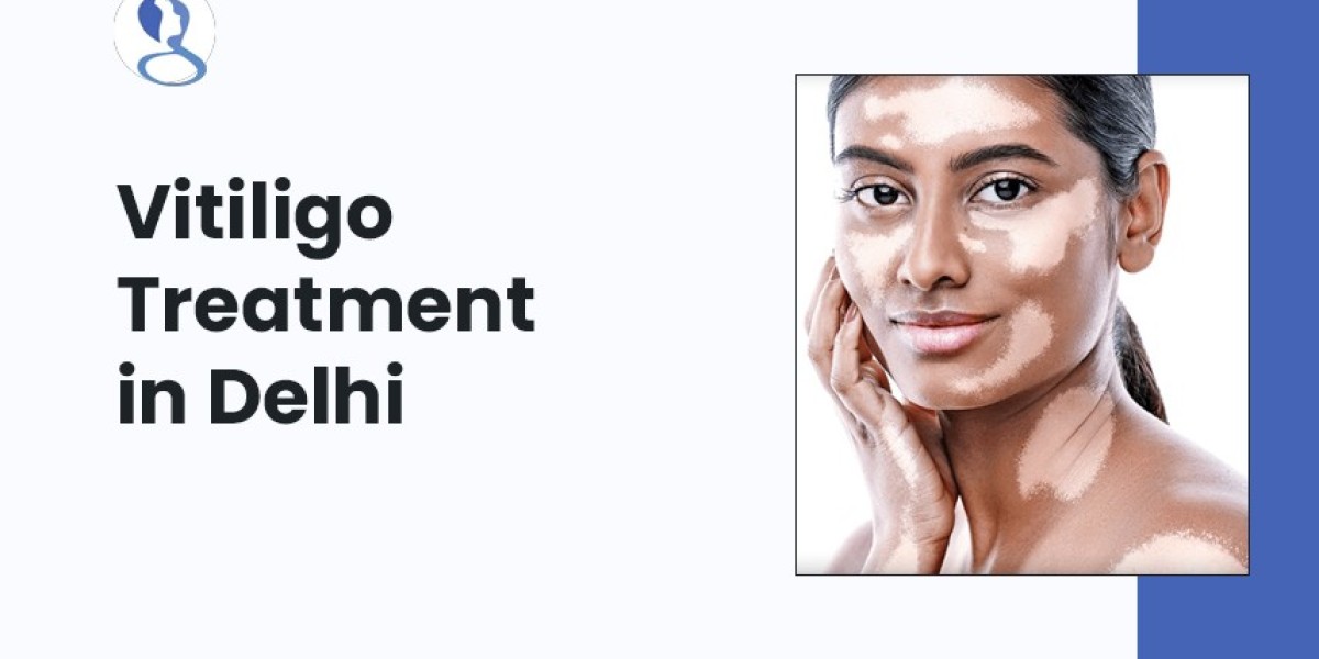 Understanding The Best Medical Treatments For Vitiligo