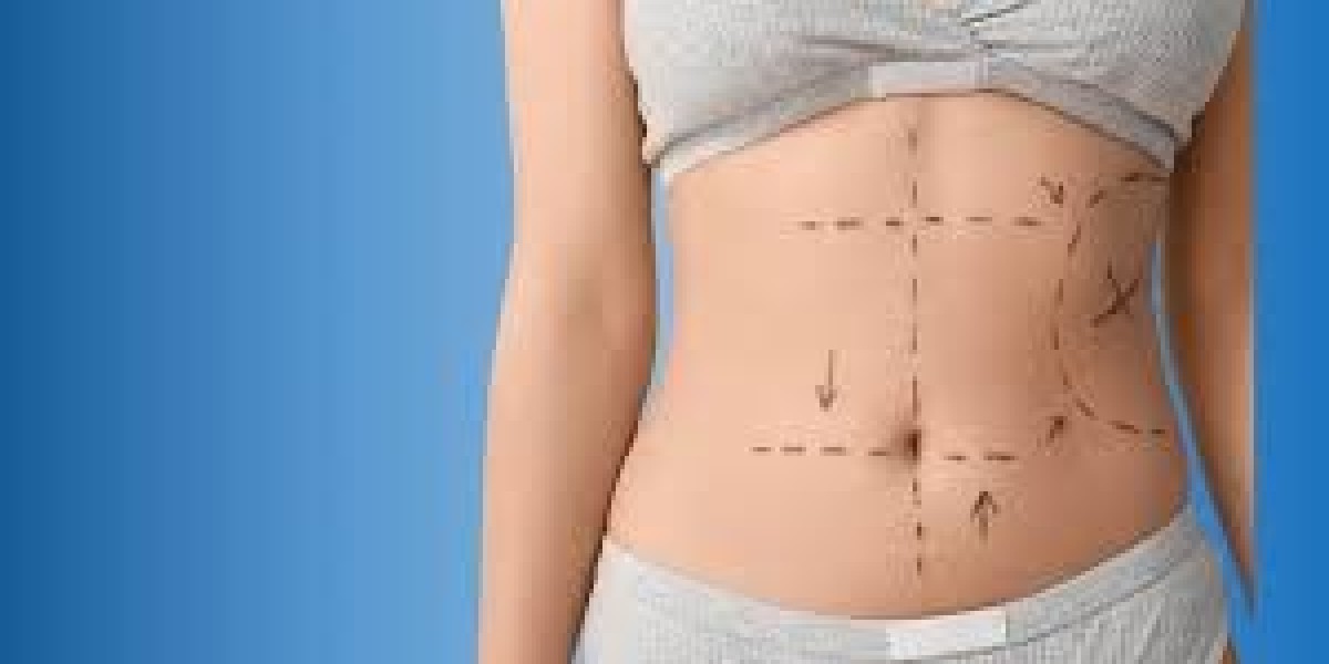 Tummy Tuck in Raleigh, NC: Get a Flatter, More Contoured Midsection